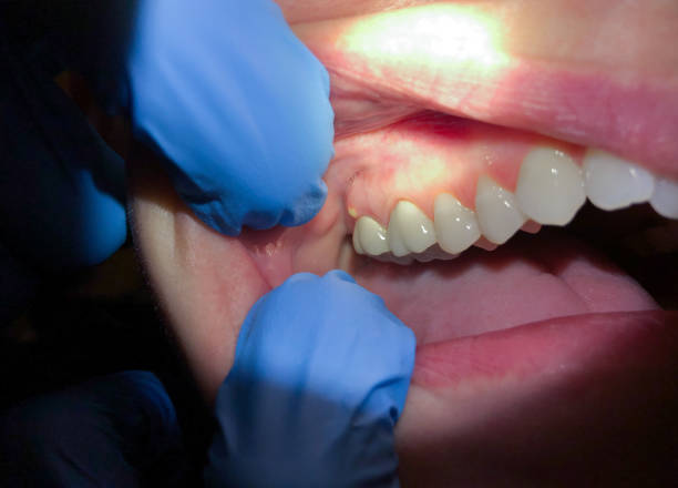 Best Emergency Care for Gum Disease in Grass Lake, MI